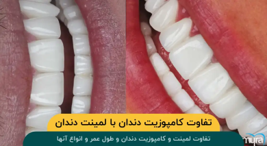 تفاوت کامپوزیت دندان با لمینت دندان
